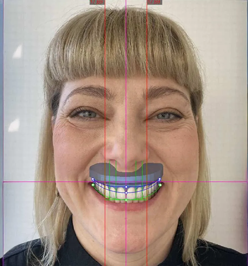 3D-Modell des Zahnbogens für die individuelle Behandlungsplanung